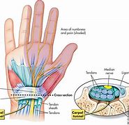 Image result for Carpal Tunnel Syndrome Brace