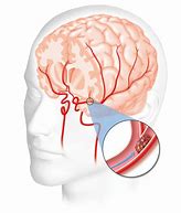 Image result for Heart&Stroke Images Clip Art