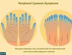 Image result for Cyanosis Legs