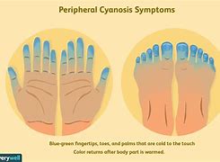 Image result for Cyanosis in Adults