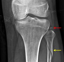 Image result for Avulsion Fracture