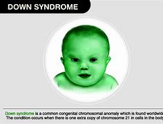 Image result for Severe Down Syndrome