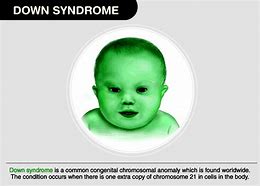 Image result for System of a Down Syndrome