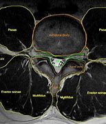 Image result for L3 L4 Sciatica