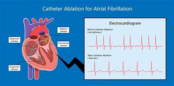 Image result for Ventricular Flutter and Fibrillation