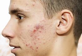 Image result for Acne On Side of Face