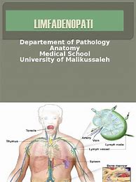 Image result for Patofisiologi Limfadenopati