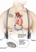 Image result for Heart Failure Electrocardiogram