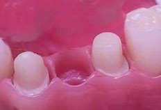 Image result for Tooth Extraction Painless