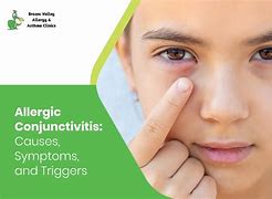 Image result for Allergic Conjunctivitis Treatment