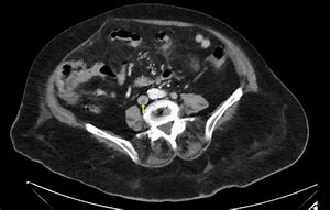 Image result for IVC Thrombs Post-Mortem