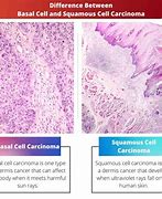 Image result for Squamous and Basal Cell Cancer