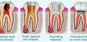 Image result for Root Canal Darkening