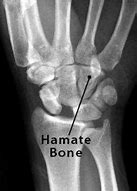 Image result for hamate bone x-ray