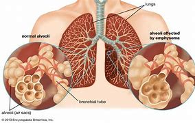 Image result for COPD Emphysema