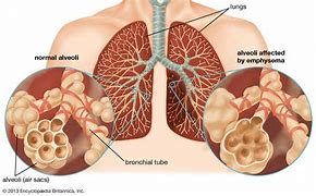 Image result for Emphysema