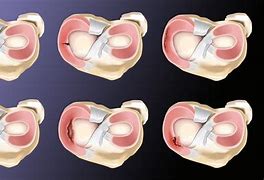 Image result for Meniscus Stress