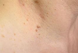 Image result for Flat Skin Warts