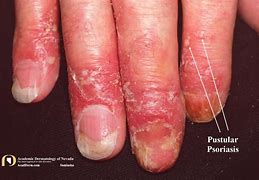 Image result for Psoriatic Pustules