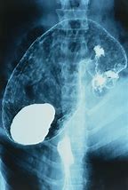 Image result for Stomach in X-ray