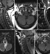 Image result for Subfalcine Meningioma CT