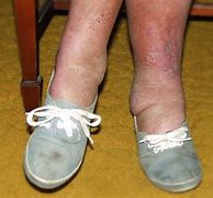 Image result for Post-Thrombotic Syndrome