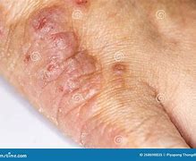 Image result for Mange On Human Skin