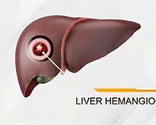 Image result for Hemangioma On Liver