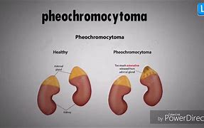 Image result for Light Bulb Sign Pheochromocytoma