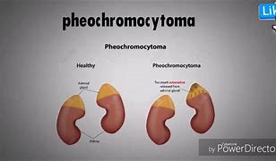 Image result for 5 Ps of Pheochromocytoma