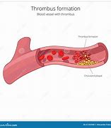 Image result for What Is a Thrombus