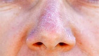 Image result for Nose Lesions