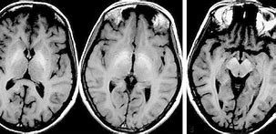 Image result for Hepatic Encephalopathy MRI