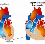 Image result for Right Ventricular Hypertrophy