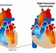 Image result for Right Ventricular Hypertrophy Echo