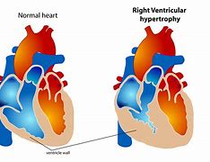 Image result for Ventricular Dilation