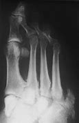 Image result for Charcot Bone Disease