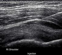 Image result for Sasd Bursitis