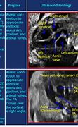 Image result for Rvot and LVOT Fetal Ultrasound Images Colour