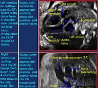 Image result for LVOT Rvot Ultrasound