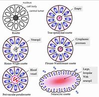 Image result for Neuropil Medulloblastoma