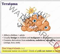 Image result for Teratoma