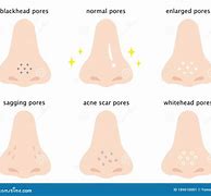 Image result for Open Nose Pores