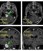 Image result for Vestibular Schwannoma Gross Pathology