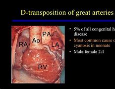 Image result for Cyanotic Heart Defect