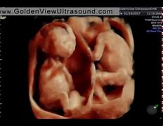 Image result for 4D Ultrasound at 15 Weeks