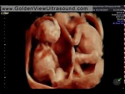 Image result for 11 Week Ultrasound Twins