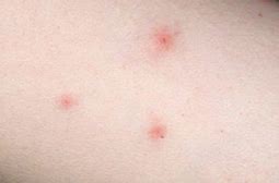 Image result for Bed Bug Bites Row