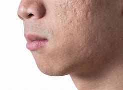 Image result for Acne Scars Men