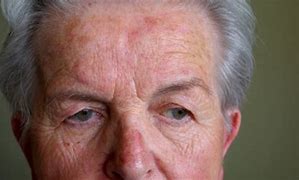 Image result for Rosacea Mites On Face